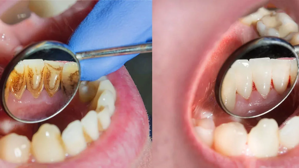 Diş Eti Hastalıkları (Periodontoloji)